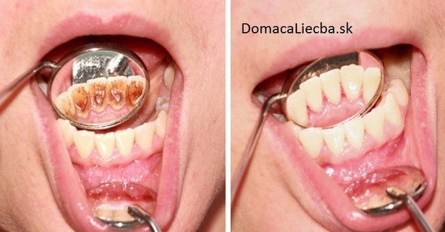 Ako sa zbaviť zubného kameňa a ochorení ďasien bez drahých procedúr