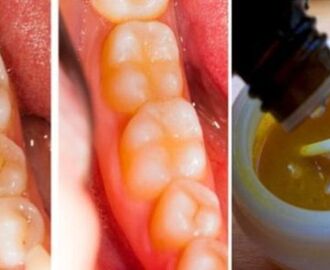 Jak wyleczyć zęby naturalnie - czy to możliwe? - Zdrowe poradniki
