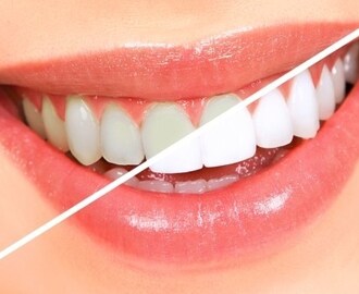 10 Dicas para você deixar seus dentes mais brancos