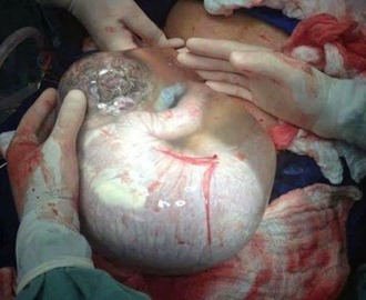Baby Born With Amniotic Sac Intact