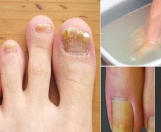 GENIJALNI TRIKOVI NAŠIH BAKA: Potopite noge u jednu od ovih mješavina i zauvijek se riješite gljivičnih infekcija na vašim stopalima!